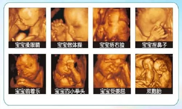 四维彩超检查什么？常州这边医院做四维彩超需要多少钱？