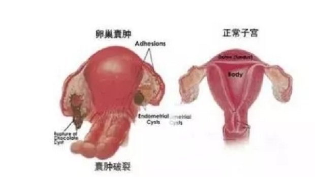 常州妇科医院 为什么女性会有肌瘤囊肿？肌瘤囊肿的困扰？