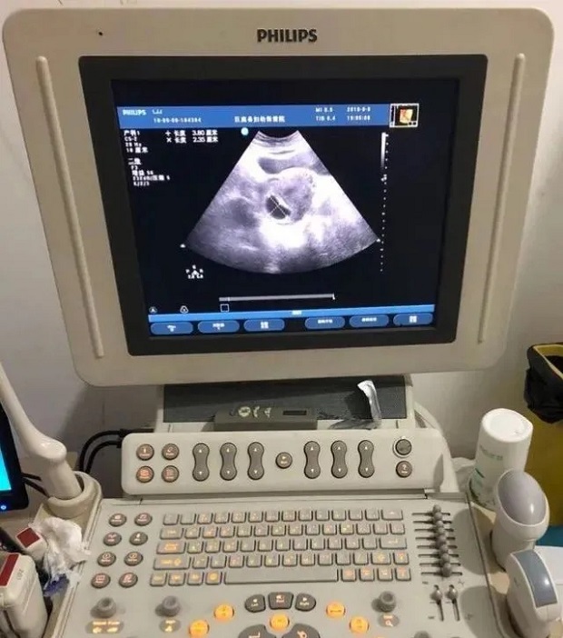 常州四维彩超 孕妈做四维彩超检查到底有什么作用？